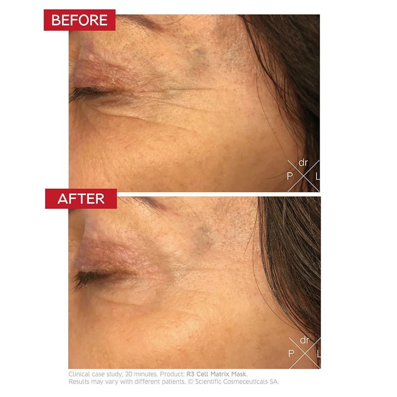 An image of a before and after of the side of a woman's face. Wrinkles are showing on the before and lesser wrinkles in the after.