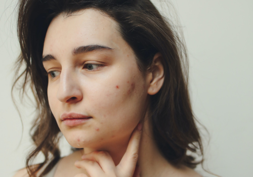 Relation between Vaping and Acne