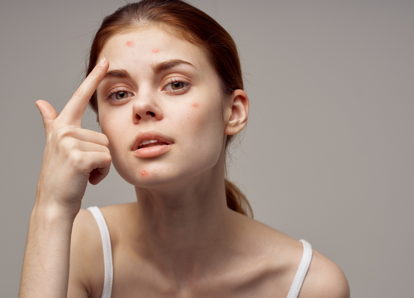 How To Treat My Acne? 5 Things To Try Now