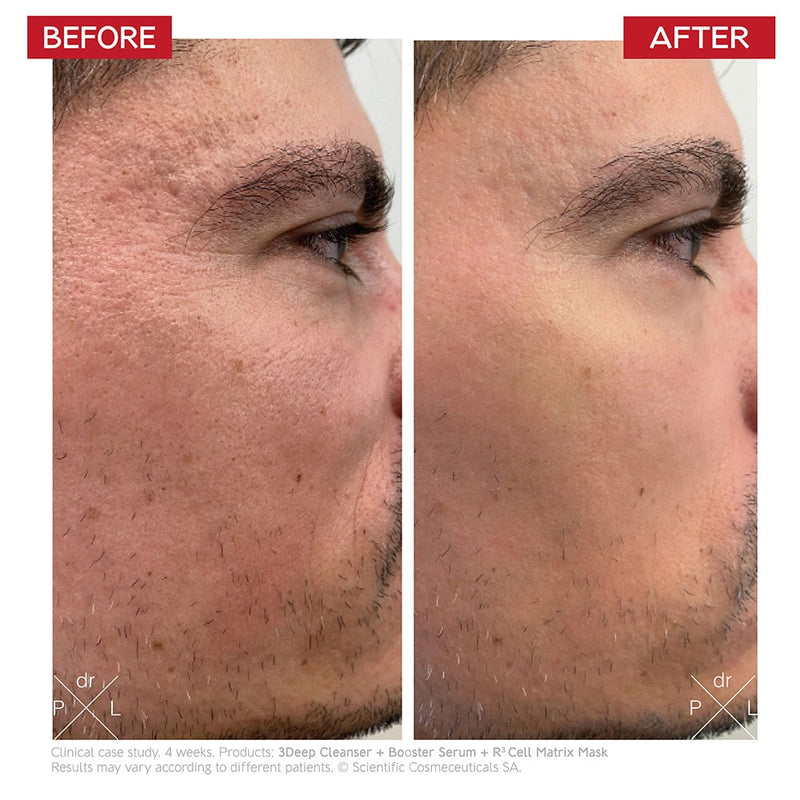 An image of a before and after of a man's face. The before photo shows visible acne scars and wrinkles and the after photo shows less visible acne scars and wrinkles.