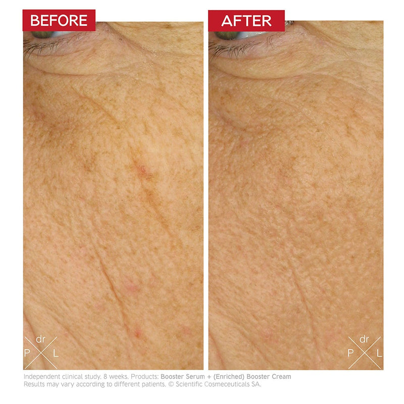 An image of a before and after of side of a woman's face. The before image shows prevalent wrinkles while the after image show less visible wrinkles on the side of her face.
