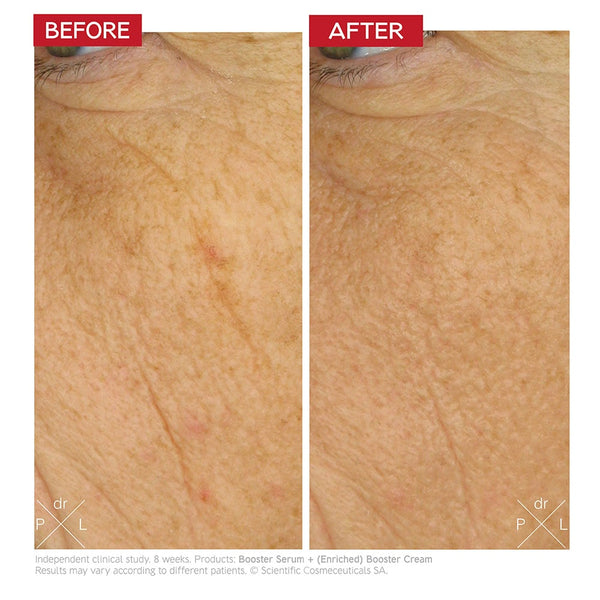 An image of a before and after showing the side face of a woman. The before photo shows visibile lines and wrinkles while the after image shows less visible lines and wrinkles.