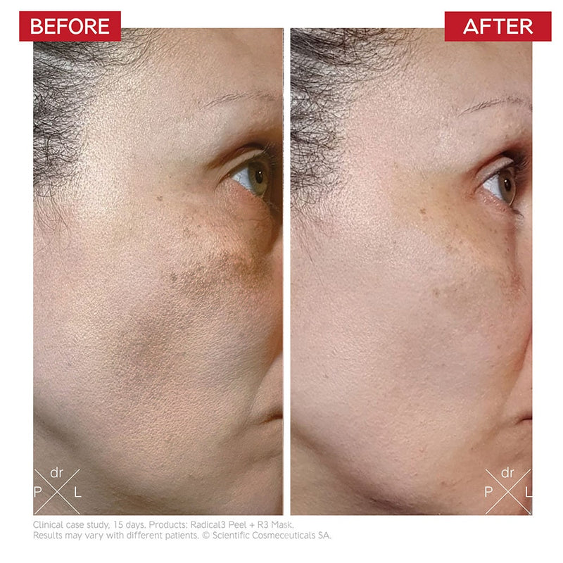An image of a before and after of a woman with melasma. On the before her melasma is darker and on the after it's less visible.